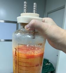 汝州水动力吸脂手术要做多久？